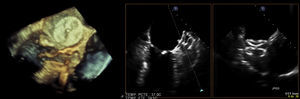 Transesophageal echocardiographic images with three-dimensional reconstruction of the Amplatzer Cardiac Plug in follow-up.