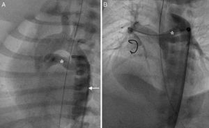 Retrograde ductal stenting in a neonate with tricuspid atresia and pulmonary atresia. (A) Ductal angiogram through a retrograde Judkins right catheter (arrow) showing duct (asterisk) arising from proximal descending aorta; (B) post-stenting ductal angiogram in the same patient showing ductal stent with good flow (asterisk) supplying confluent pulmonary artery branches.