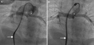 Antegrade ductal stenting in a neonate with pulmonary atresia and ventricular septal defect. (A) Ductal angiogram through a transvenous Judkins right catheter (arrow) showing a tortuous duct (asterisk) arising vertically and proximally from the undersurface of the aortic arch; (B) post-stenting ductal angiogram through a transvenous Mullins sheath and Judkins right catheter (arrow) in the same patient, showing ductal stent with good flow (asterisk).