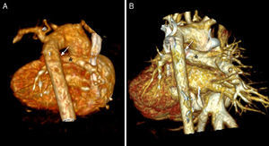 Volume-rendered three-dimensional computed tomography images of an infant with double-outlet right ventricle and pulmonary atresia. (A) Baseline image showing tortuous duct with constrictions (arrow) and confluent pulmonary branches (asterisk); (B) follow-up image after six months showing duct with good ductal flow (arrow) and pulmonary branches with appropriate growth (asterisk).