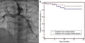 Re-interventions. (A) Re-intervention via an axillary artery route for left pulmonary artery (LPA) stenosis showing negotiation of a balloon (arrow) through the ductal stent into the LPA; (B) Kaplan-Meier analysis showing freedom from re-intervention and from surgical re-intervention at follow-up.