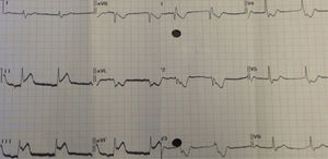 Electrocardiogram following symptom onset.