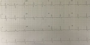 Electrocardiogram following coronary angiography.