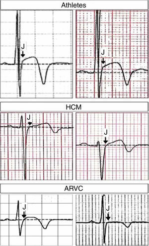 Close-up of lead V3 in different clinical conditions. Top: J-point elevation preceding T-wave inversion (both panels from healthy athletes); middle: ST-segment elevation (without J-point elevation) preceding T-wave inversion (both panels from patients with hypertrophic cardiomyopathy); bottom: ST-segment elevation (without J-point elevation) preceding T-wave inversion (both panels from patients with arrhythmogenic right ventricular cardiomyopathy). Arrows indicate the J-point. ARVC: arrhythmogenic right ventricular cardiomyopathy; HCM: hypertrophic cardiomyopathy. Adapted from Calore et al.11 with permission from Oxford University Press.