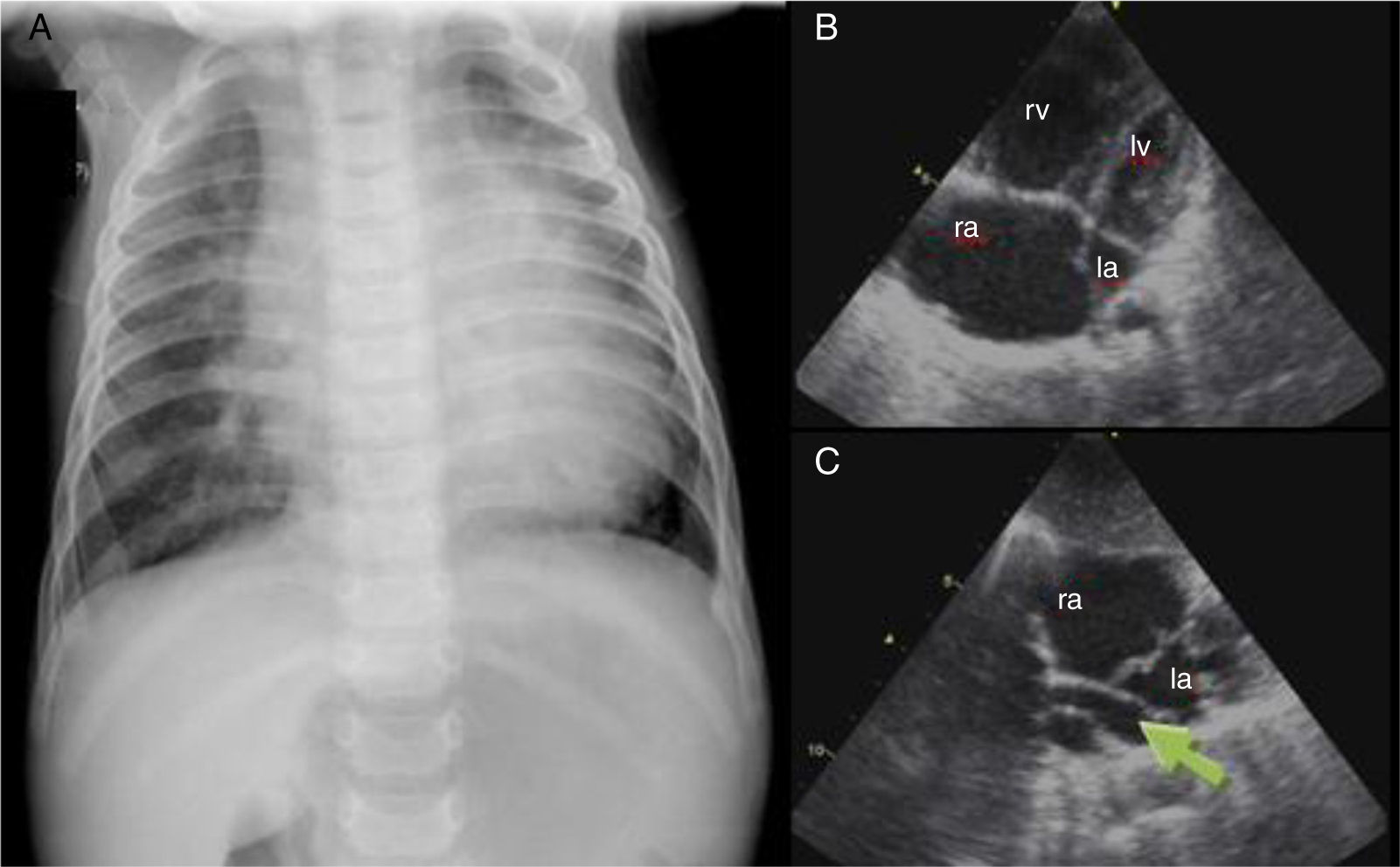 Atrium Connection Anomalous pulmonary venous connection: An underestimated entity ...