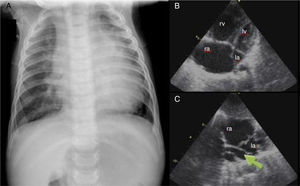 (A) Chest X-ray showing cardiomegaly and moderate pulmonary venous congestion; (B) dilatation of the right chambers; (C) total anomalous pulmonary venous connection, with no communication between the pulmonary veins and left atrium and a common vertical vein (arrow). la: left atrium; lv: left ventricle; ra: right atrium; rv: right ventricle.