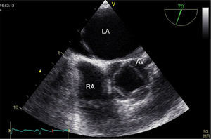 Transesophageal echocardiography, short-axis view during systole, showing quadricuspid aortic valve. AV: aortic valve; LA: left atrium; RA: right atrium.