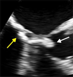 Two-dimensional transesophageal echocardiography, long-axis view (120°), showing a mass adjacent to the mitral posterior annulus (yellow arrow), directed toward the left ventricular outflow tract (white arrow).