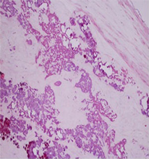 Histology showing dystrophic calcifications and fibrosis, with no other changes and no evidence of inflammation or tumor.