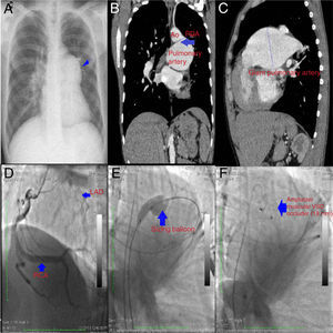 (A) Chest X-ray showing cardiomegaly and enlargement of the left pulmonary hilum (blue arrow); (B) computed tomography (CT) image revealing a patent ductus arteriosus (PDA) in the frontal plane (blue arrow); (C) CT image showing a giant left pulmonary artery (8.32 cm); (D) coronary angiography showing a single coronary artery originating from the right coronary artery; (E) sizing balloon measuring the diameter of the PDA; (F) the duct is occluded by an Amplatzer muscular ventricular septal defect occluder.