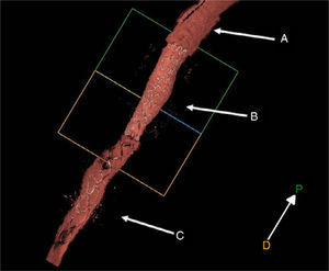 (A) Bioresorbable strut; (B) polymer stent graft strut; (C) metal strut of the drug-eluting stent.