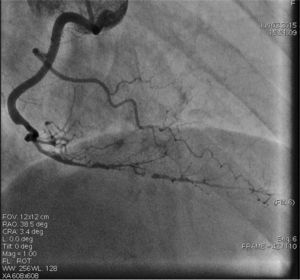 First angiogram of the right coronary artery (RCA), showing a long spontaneous coronary artery dissection from the distal RCA to the distal posterior descending artery and posterolateral branches.