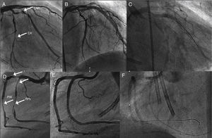 Coronary angiography showing (A) 85% long stenosis of the first obtuse marginal branch and 80% stenosis of the distal circumflex (CX) artery (arrows); (B) these lesions treated with two and one drug-eluting stents (DES), respectively; (C) the CX with gadolinium contrast after six months; (D) early right coronary artery (RCA) bifurcation, 90% stenosis of the right posterolateral branch (RPL) (arrows), 90% at the origin of the posterior interventricular artery (PIA) and 80% distal to the PIA; (E) these lesions treated with two DES in the RPL, one DES at the origin of the PIA and another in the distal segment of the PIA; (F) coronary angiography of the RCA with gadolinium contrast after six months. CX: circumflex artery; OM1: first obtuse marginal branch; PIA: posterior interventricular artery; RPL: right posterolateral branch.