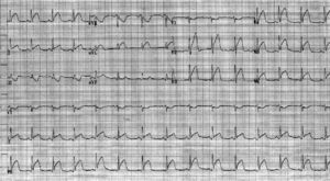 Electrocardiogram showing ST-segment elevation in leads I, aVL, and V2-6 consistent with acute anterior/lateral ST-segment elevation myocardial infarction.