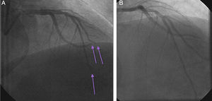 (A) Emergency coronary angiogram on hospital admission showing total occlusion of the left anterior descending, second diagonal artery and second obtuse marginal arteries (arrows); (B) after successful intracoronary aspiration by aspiration catheter, the lesions were fully reperfused.