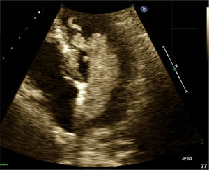 Echocardiogram showing a villous left atrial myxoma prolapsing into the left ventricle in the diastolic phase.