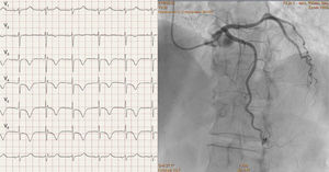 Left: resting electrocardiogram with negative T waves and prolonged QT interval; right: intermediate coronary stenosis in the mid left anterior descending artery.