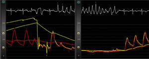 Left: afterdepolarizations and initiation of polymorphic ventricular tachycardia (VT) following adenosine injection. Note the absence of catheter damping or ischemia; right: self-termination of the VT, with restoration of blood pressure and minimal separation between pressure curves (Pd, red curve; Pa, yellow curve). Further adenosine injections demonstrated a minimum fractional flow reserve of 0.93 (non-significant).