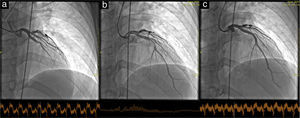 Acute thrombosis of the left anterior descending artery, TIMI flow 0 (a); spontaneous reperfusion revealing a massive thrombus in segment 7 (b); status following stent implantation, TIMI flow 3 (c).