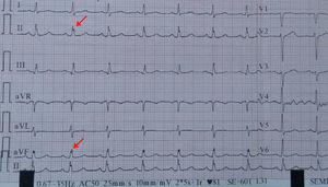 An example of fragmented QRS in the inferior leads.