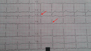 An example of fragmented QRS in the anterior leads.