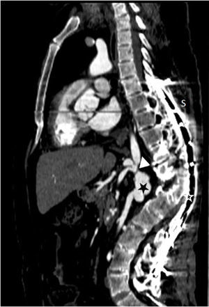 Sagittal plane reformation showing severe narrowing of the aorta (arrow) and a saccular aneurysm (star) at the level of the renal arteries. Metal artifacts caused by spinal surgical procedure (S) can also be seen.