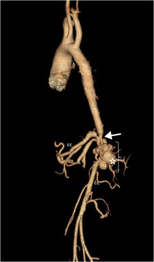Three-dimensional angiographic sequences demonstrating collateral circulation with engorged vessels (CC), a saccular aneurysm (star) and aortic stenosis (arrow).