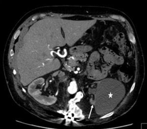 Axial computed tomography scan showing atrophy of the left kidney caused by subtotal renal artery stenosis (arrow) and a left simple renal cyst (star).