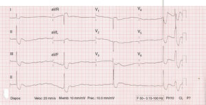 Complete atrioventricular block with premature ventricular complex.