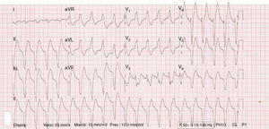 Ventricular tachycardia.
