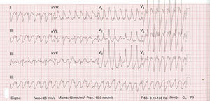 Bidirectional ventricular tachycardia.