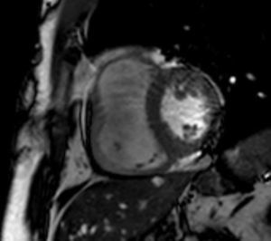 Cardiac magnetic resonance imaging showing marked right ventricular dilatation.