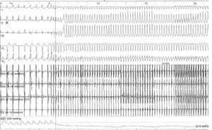 Electrophysiologic study showing inducibility of monomorphic ventricular tachycardia with complete left bundle branch block.