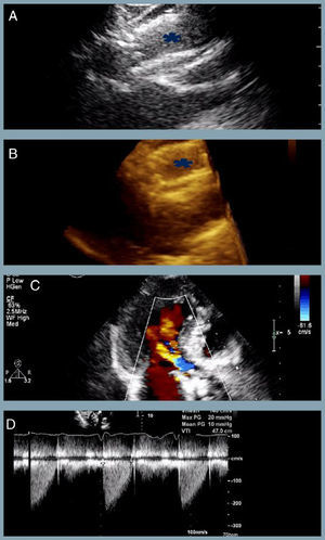 The last transthoracic echocardiography (at one-year follow-up) revealing (A and B) partial overlapping of the two bioprostheses (blue asterisk) (two- and three-dimensional respectively); (C) mild to moderate associated periprosthetic leak; (D) appropriate transprosthetic gradients (maximum and mean of 20 mmHg and 10 mmHg, respectively).