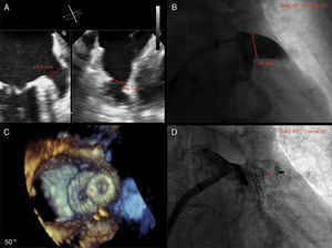 (A) Left atrial appendage (LAA) size by biplane two-dimensional transthoracic echocardiography (TEE); (B) LAA size by angiography (windsock morphology); (C) three-dimensional TEE showing complete occlusion of the LAA with the Amulet device (red asterisk); (D) angiography showing complete occlusion of the LAA with the Amulet device (red asterisk).