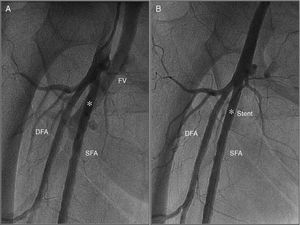 (A) Angiography obtained from the contralateral femoral artery (left) revealing a high-output arteriovenous fistula between the right superficial femoral artery and femoral vein (white asterisk); (B) angiography after implantation of a 26 mm×4.5 mm PK-Papyrus covered coronary stent (white asterisk) revealing complete sealing of the AV fistula. DFA: deep femoral artery; FV: femoral vein; SFA: superficial femoral artery.