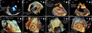 Percutaneous closure of ostium secundum atrial septal defect, associated with aneurysm of the atrial septum, using three-dimensional transesophageal echocardiography imaging (see text for details).