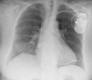 Chest radiography: progression of the right ventricular lead beyond the cardiac silhouette.