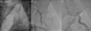 Left heart catheterization: (A) radial access made impossible due to the tortuosity of the subclavian artery, which prevented passage of the guidewire; (B) contrast-guided puncture of the left femoral artery; (C) catheterization by femoral access revealing a mobile thread-like structure (arrow), consistent with a thrombus.