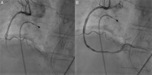 Right coronary angiography: (A) occlusion of the mid segment of the right coronary artery; (B) reperfusion following aspiration of the thrombus.