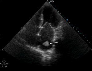 Transthoracic echocardiography, apical 4-chamber view, showing a hyperechoic and extremely mobile image (arrow) in the left atrium, consistent with a thrombus.