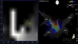 Left: rotor recording with the FIRM system; right: posteroanterior view of the left atrium with CARTO mapping showing rotors (blue and pink circles) over a stable complex fractionated atrial electrogram (red area). CFAE: complex fractionated atrial electrogram; LIPV: left inferior pulmonary vein; LSPV: left superior pulmonary vein; RIPV: right inferior pulmonary vein; RSPV: right superior pulmonary vein.