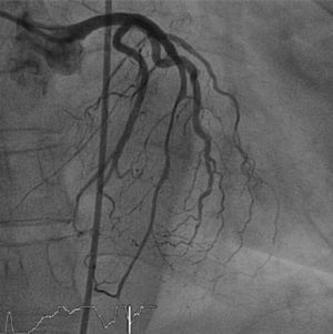 Coronary angiography revealing a long 50% stenosis in the mid-distal portion of the left anterior descending artery and a 30% focal stenosis in the mid segment of the right coronary artery.