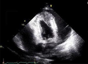 Echocardiogram showing a large pericardial effusion with diffuse thickening of the myocardium.