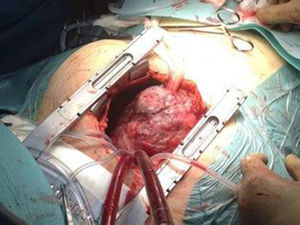 Intraoperative photograph of the tumor.