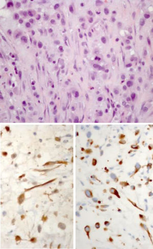 Immunohistochemical study documenting diffuse expression of AE1/AE3, vimentin and MDM2 in tumor cells and focal expression of calretinin, EMA, podoplanin, desmin and p53.