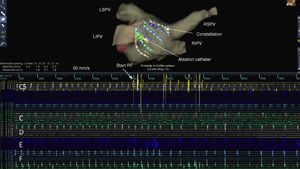 Above, anatomical mapping of the left atrium with the Constellation catheter and the ablation catheter. Below, coronary sinus electrograms and electrograms from the splines of the diagnostic catheter. The posterior wall is represented from splines C to F. Immediately after initiation of radiofrequency application, an increase in cycle length in the posterior wall is noted (scale 50 mm/s). LIPV: left inferior pulmonary vein; LSPV: left superior pulmonary vein; RF: radiofrequency; RIPV: right inferior pulmonary vein; RSPV: right superior pulmonary vein.