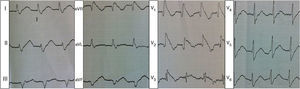 Electrocardiogram at admission showing coved ST-segment elevation in V1 and V2 followed by a negative T wave.