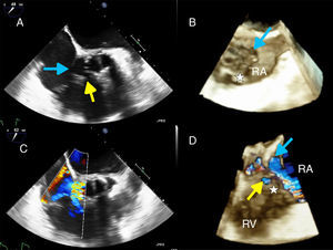 Transesophageal echocardiography in mid-esophageal view: (A) two-dimensional transesophageal echocardiography (2D-TEE) showing a cavity between the aortic prosthesis and the right atrium RA corresponding to a PA, which communicates with the RA (blue arrow) and with the RV through the base of the TSL (yellow arrow); (B) three-dimensional transesophageal echocardiography (3D-TEE), showing the PA from the RA in the middle of the image, the aortic prosthesis on the left, the superior vena cava on the right, the interatrial septum at the top and the TSL at the bottom; (C) 2D-TEE showing turbulent flow from the PA to the RA and to the RV; (D) 3D-TEE image showing the same defects in more detail. PA: pseudoaneurysm; RA: right atrium; RV: right ventricle; TSL: tricuspid septal leaflet.