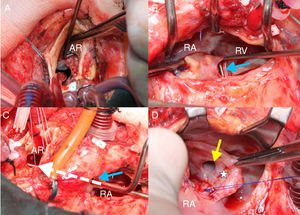 Surgical photographs: (A) a small defect in the anterior area of the aortic annulus; (B) the PA with a previous pericardial patch after the RA was opened; (C) a defect communicating with the perimembranous septum (blue arrow); (D) the PA after being opened with a defect communicating with the RV (yellow arrow) through the base of the TSL (white star). PA: pseudoaneurysm; RA: right atrium; RV: right ventricle; TSL: tricuspid septal leaflet.